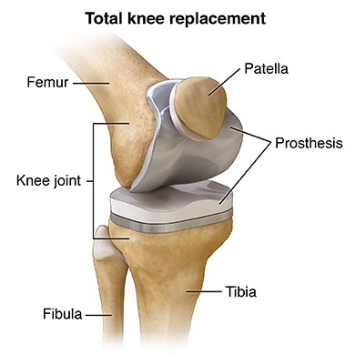 afbeelding van metalen delen in de knie.jpg